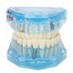 thumbnail image 5 of Modelo de dientes de enfermedad dental BuyWeekMX transparente, 5 of 9
