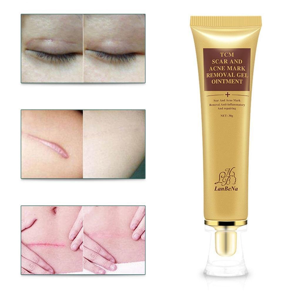 LanBeNa Pimple Scar Acne Mark Spots Removal Treatment Gel Ointment Blemish Cream - image 4 of 8