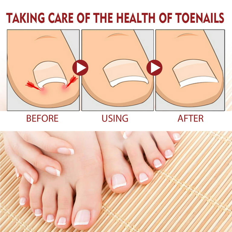 Haobuy 3pcs Toenailplus Anti Paronychia Relief Oil, Toe and Fingernail  Repair for Damaged Discolored Thick Nails