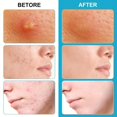 thumbnail image 2 of 28 Pcs Flower-Shaped Pimple Patches - Safely Remove Acne & Blemishes Without Irritation!, 2 of 4
