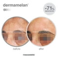 thumbnail image 5 of Mesoestetic Dermamelan Treatment Cream Pigment Control Solutions 30 g / 1.06 oz, 5 of 5