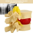 thumbnail image 1 of Modelo De Hernia De Disco Lumbar Humana, Práctica Profesional, Vértebras Lumbares Humanas Simuladas Degenerativas, Duraderas Para La Enseñanza Clínica De Ortopedia, 1 of 7
