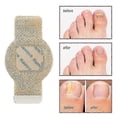 thumbnail image 2 of fungus nail patches for discoloured or ingrown nails, 2 of 5