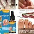 thumbnail image 4 of Gel para eliminar hongos en las uñas, crema antiinfección, 22 piezas, 10ML, 4 of 5