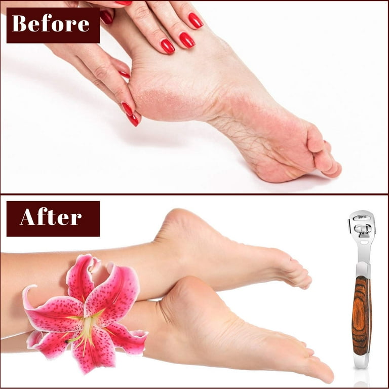 JESOT Callus Shaver, Foot Shaver Callus Remover for Feet Hand Care