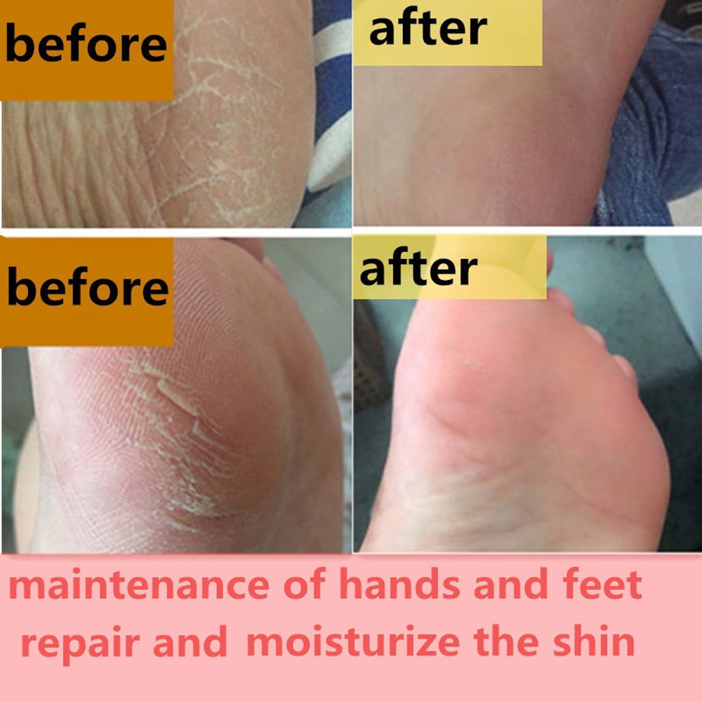 Yotyukeb Oil Feet Cream Care Athlete S Foot Itch Blisters Peeling Bad Feet Ointment Walmart Com