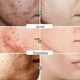 thumbnail image 5 of Crema Limpieza Facial Anti Acné Cicatrices Ácido Salicílico, 5 of 7