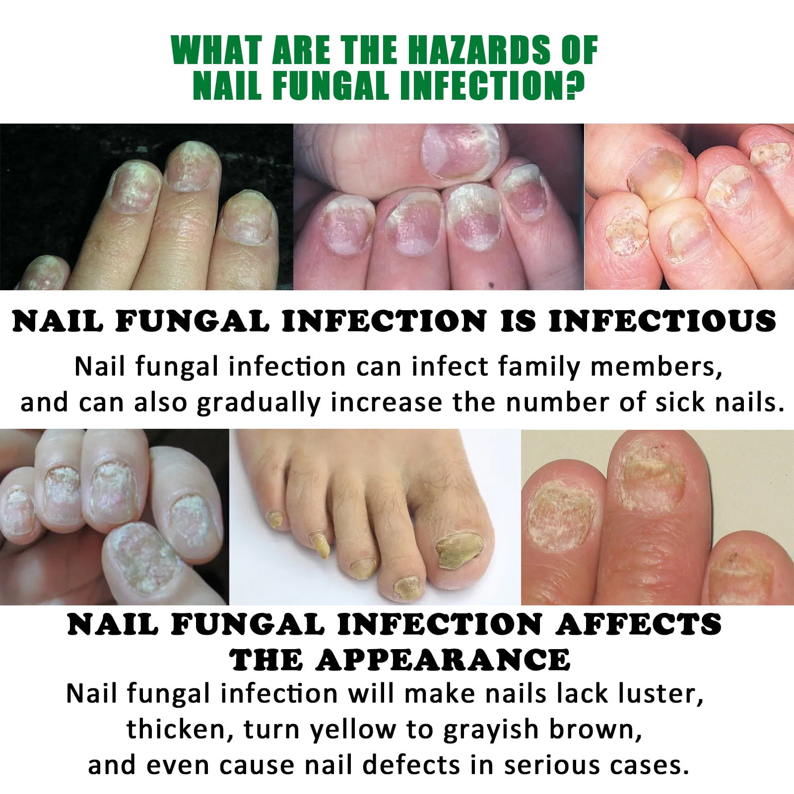Brittle Nails: Causes, Symptoms, Treatment and Home Remedies | Femina.in