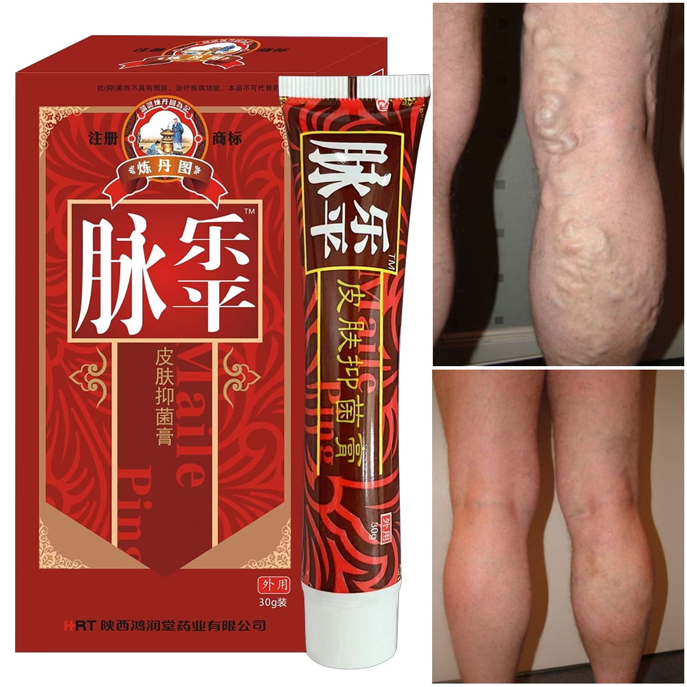 2PCS Varicose Cream,Relief Inflammation Vein Veins Treatment Legs Care Cream ,Health Care Ointment Phlebitis Itching Cream