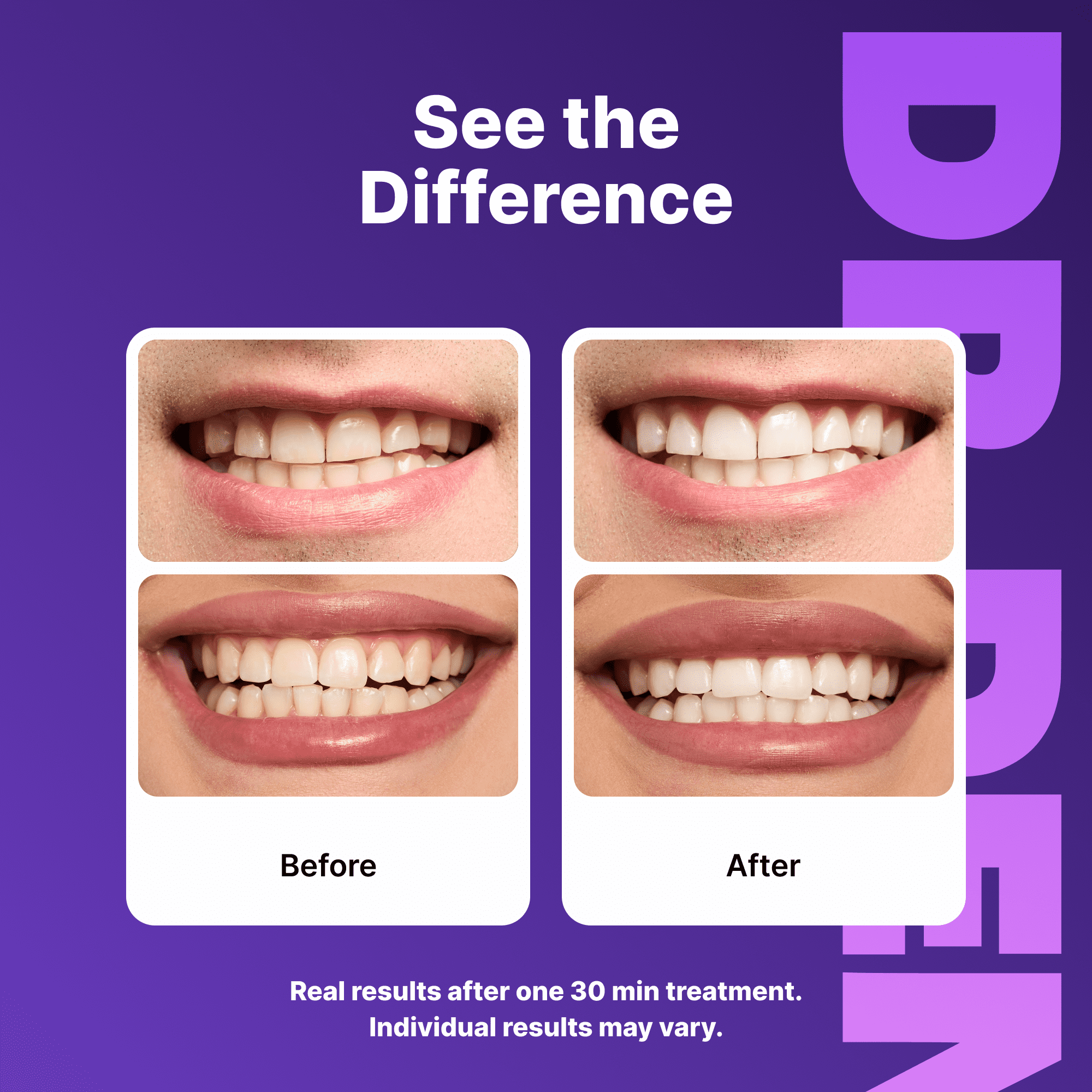 DRDENT Purple Teeth Whitening Strips 21 Treatments - Safe for Enamel - Non Sensitive Teeth Whitening - Whitening Without Any Harm - Pack of 42 Strips