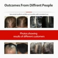 thumbnail image 5 of 2026 Upgrade Laser Cap, Red Light Therapy for Hair Growth, 5 of 7