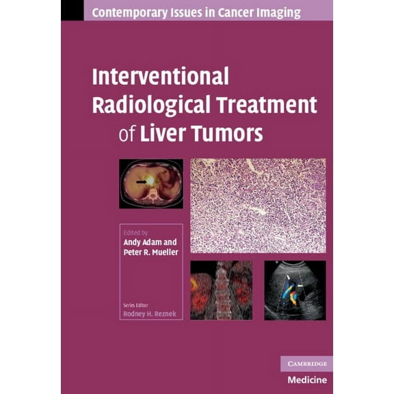Contemporary Issues in Cancer Imaging Interventional Radiological Treatment of Liver Tumors, (Hardcover)