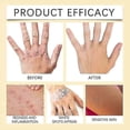 thumbnail image 4 of vitiligo skin care cream portable anti-itch treatment, 4 of 5