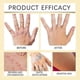 thumbnail image 4 of vitiligo skin care cream portable anti-itch treatment, 4 of 5