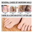 Advanced Treatment Ingrown Toenail Drops