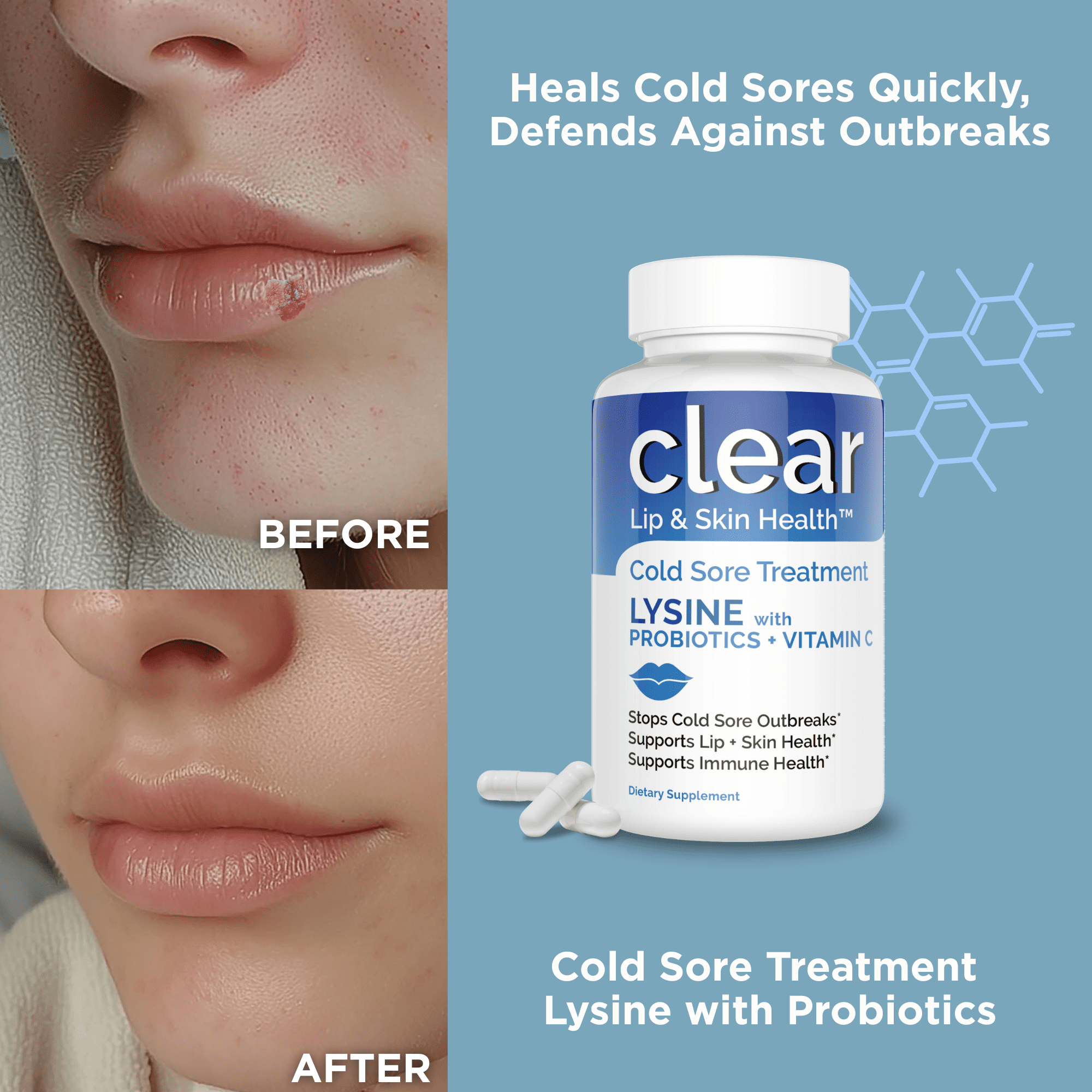 vitamin c sore lip Lysine Cold Sore Treatment Capsules with Pre-Probiotics & Vitamin C,  Rhamnosus & Acidophilus – 1 Month Supply for Cold Sore Relief, Skin, Gut &  Immune