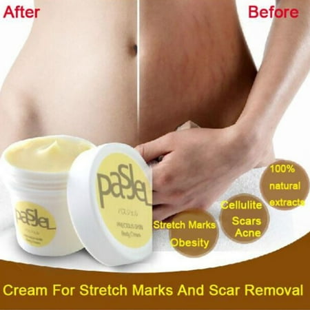 Repair Cream For Stretch Marks, Remover Scar, Powerful Postpartum Obesity Pregnancy