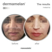 Mesoestetic Dermamelan Treatment Cream Pigment Control Solutions 30 g / 1.06 oz
