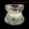 thumbnail image 4 of Dental Model Teeth Implant Restoration Bridge Teaching for Study Tooth Science, 4 of 5