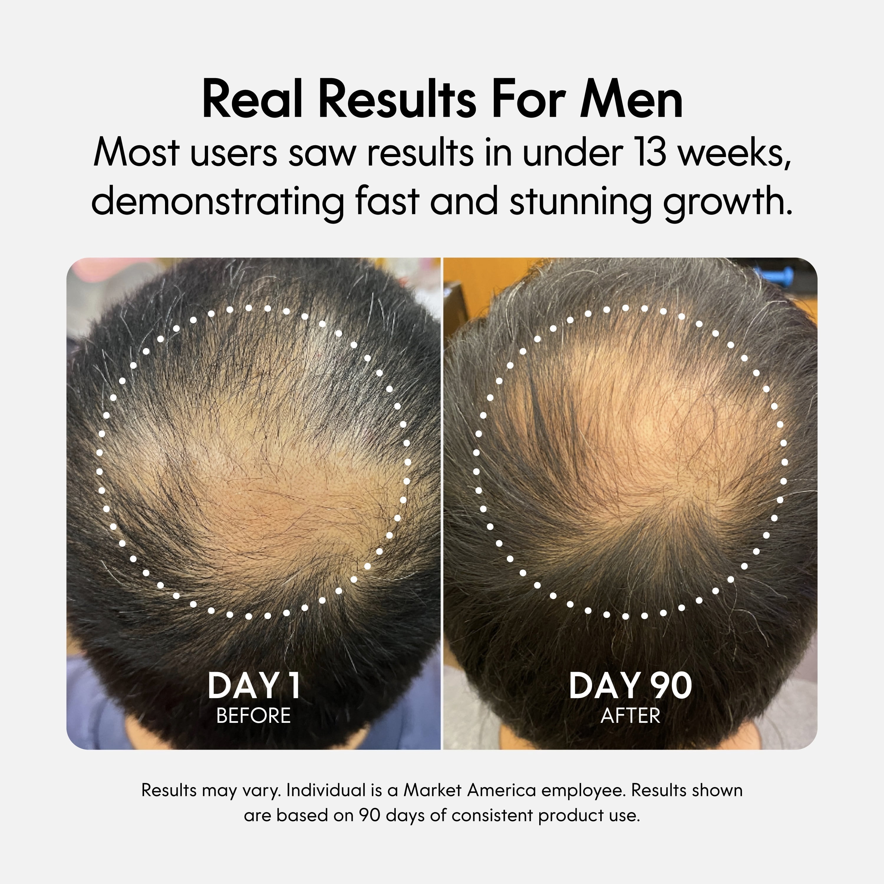 Fixx Hair Growth Duo – 2-Step System with Hair Regrowth Tablets & Exosome Scalp Serum – Biotin, Caffeine & Ginseng – For Men & Women
