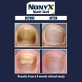 thumbnail image 5 of NonyX Fungal Nail Clarifying Gel, 4 oz, 5 of 6