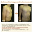 thumbnail image 4 of Pectus Excavatum Vacuum Bell - Pectus Excavatum Orthosis Brace,Physical Correction,Washable,Real-Time Pressure Monitoring,Easy to Operate, 4 of 8