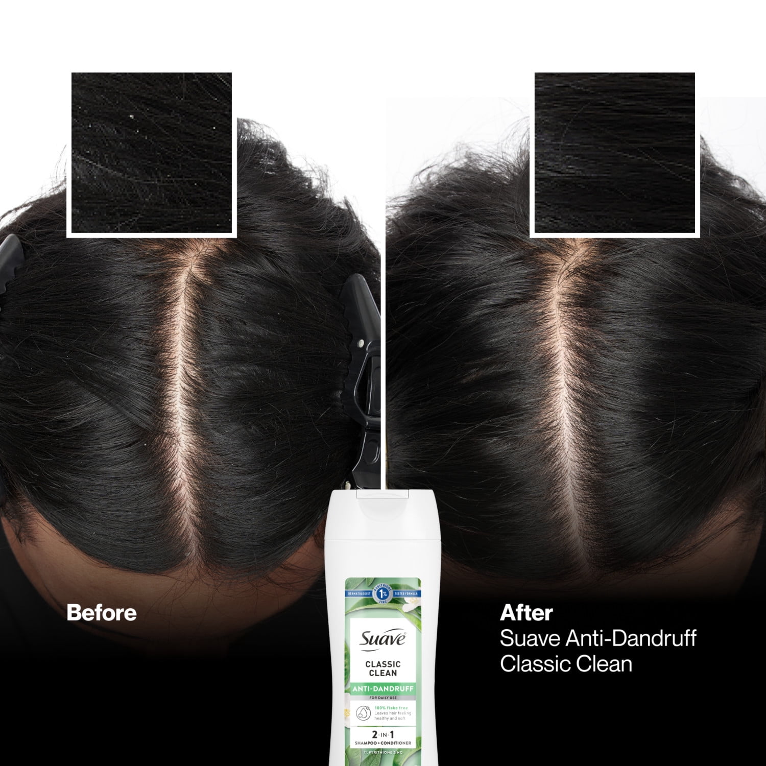 (6 pack) Suave Anti Dandruff 2 IN 1 Shampoo & Conditioner For Women, Classic Clean, 12.6 FL OZ