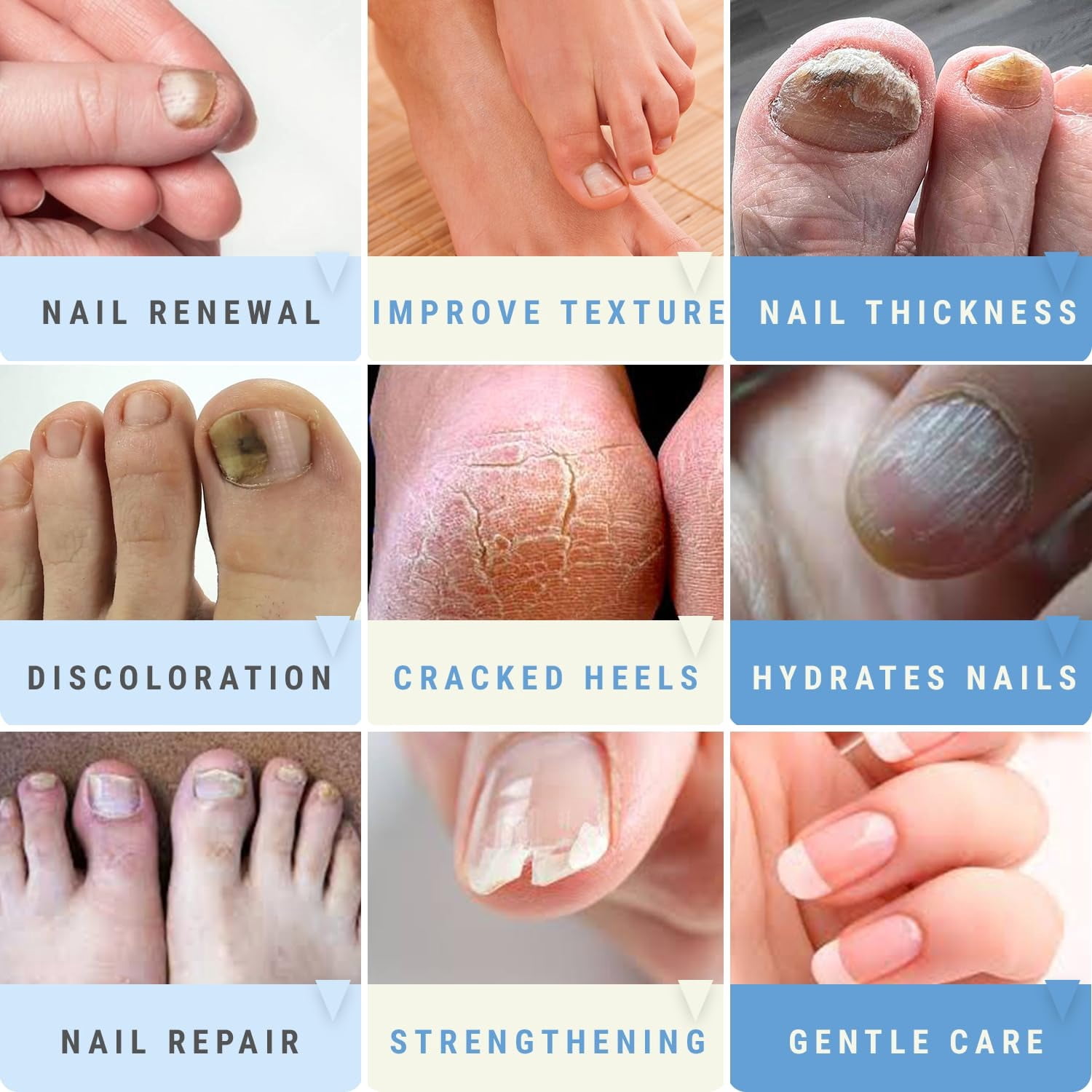 50% Urea Nail Gel - Softens Cracked Heel Calluses & Thick Toenails - Repairs Damaged, Yellow, Discolored Nails – Highly Effective & Quick-Dry Fingernails & Toenail Treatment | Made in USA