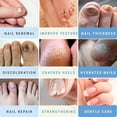 thumbnail image 6 of 50% Urea Nail Gel - Softens Cracked Heel Calluses & Thick Toenails - Repairs Damaged, Yellow, Discolored Nails – Highly Effective & Quick-Dry Fingernails & Toenail Treatment | Made in USA, 6 of 7