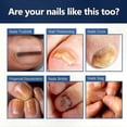 thumbnail image 2 of Nourishing Nail Repair Cream for Discolored and Damaged Nails, 20g Anti-Fungal Treatment, 2 of 4