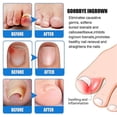 thumbnail image 4 of Toenails Nail Care Cream, Nail Fungus Treatment Cream, Toe Nail Fungus Treatment Nail Repair Care Cream, 4 of 5