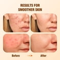 thumbnail image 2 of Sérum BIYSBER Ácido Salicílico 2% Hidratante para Cuidado del Acne 30ml, 2 of 8