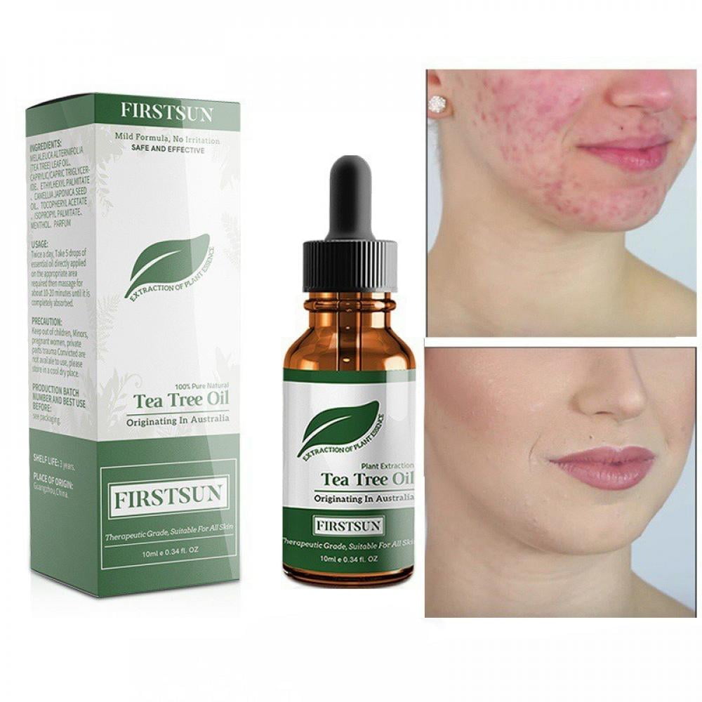 Pretty Comy Tea Tree Essential Oil Nourishing Skin Shrink Pores Control Oil Skin Care Product