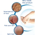 thumbnail image 4 of Jinsinto Pedicure Foot Rasp, Double-Sided Exfoliator, Callus Remover, Natural Foot Pumice Stone, Remove Dead Skin, 4 of 5