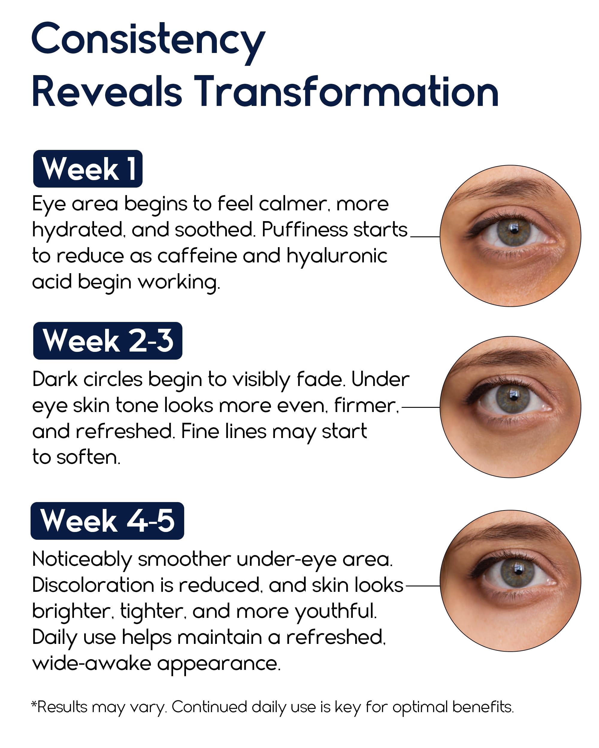 Under Eye Cream for Puffiness and Bags Under Eyes - Eye Bags Treatment for Men & Women - Anti Wrinkle Cream for Dark Circles, Baggy Eyes Treatment for Women with Retinol, Hyaluronic Acid & Caffeine