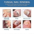 thumbnail image 3 of Extra Strong Fungal Nail Treatment - Effective Solution For Finger & Toenail Fungus, Protects Thick, Broken, Discolored Nails, Restores Discolored Nai, 3 of 5