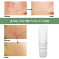 thumbnail image 4 of Crema para eliminar el acné, crema para espinillas, crema Facial hidratante de reparación para el cuidado de la piel, 30ml, 4 of 8