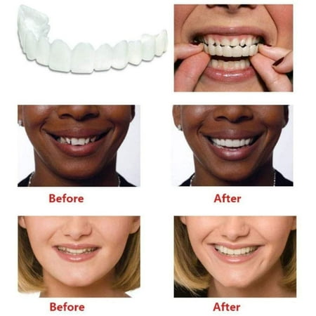 denture dentures instant serrated veneers