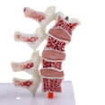 thumbnail image 4 of 1:1 Human Lumbar Vertebra Thighbone Osteoporosis Pathology Model Kit, 4 of 9