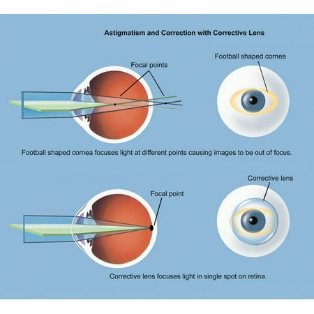 Astigmatism and correction with corrective lens Poster Print by TriFocal CommunicationsStocktrek Images