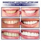 thumbnail image 3 of 14 Uds pegatinas para blanquear los dientes Gel blanqueador tiras para blanquear los dientes cuidado de los dientes Sywqhk Cuidado Belleza, 3 of 9