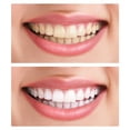 thumbnail image 4 of Labymos Fake Teeth, 2 PCS Dentures Teeth for Upper and Lower Jaw, Nature and Comfortable,, 4 of 8
