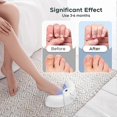 thumbnail image 2 of Portable Nail Fungus Laser Treatment Device - 905nm Infrared & 470nm Blue Dual Light Therapy for Toenails Fingernails, Home Use, 2 of 5