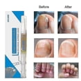 thumbnail image 3 of Liquid Anti Nail Toenail Fungus Care Solution Anti Fungal Nail Repair Liquid Anti Fungus Nail Liquid Nai, 3 of 5