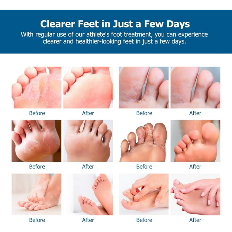 Roycederm Athletes Foot Treatment: Extra Strength Foot Treatment