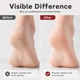Foot File Scraper Dual-Sided Foot Callus Remover, Stainless Steel Foot File, Heel Scraper ...