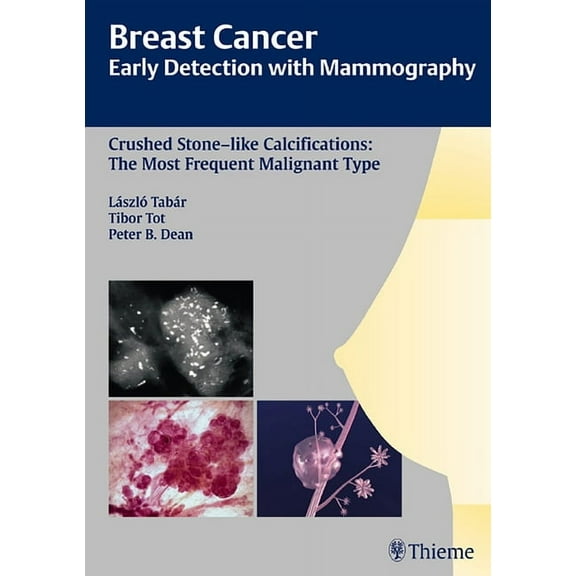 Tabar Mammo Breast Cancer: Early Detection with Mammography: Crushed Stone-Like Calcifications: The Most Frequent Malignant Type, (Paperback)
