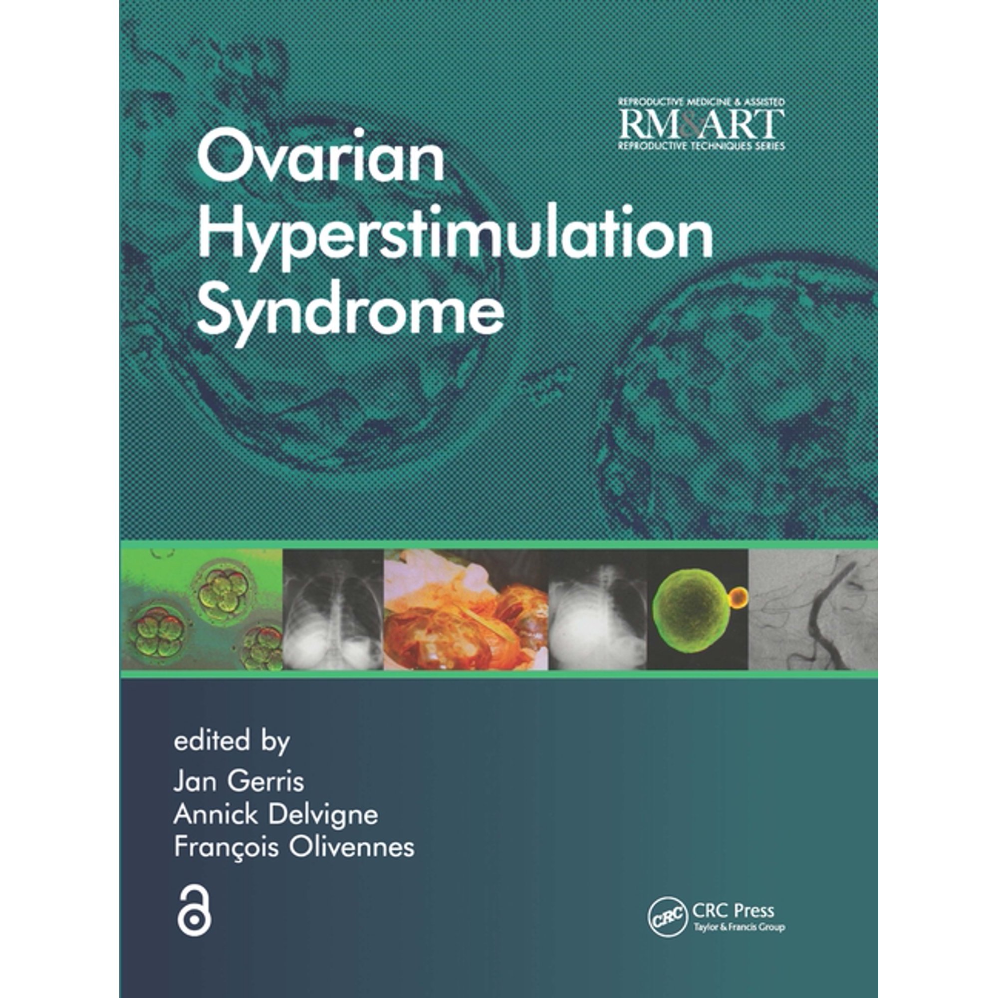 Reproductive Medicine and Assisted Reproductive Techniques: Ovarian Hyperstimulation Syndrome (Hardcover)