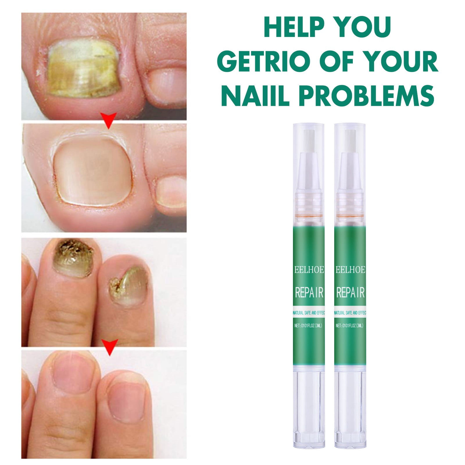 Nail Fungus Treatment Repair Clean Pen For Renews Yellow Cracked Split Nail 3ml Walmart Com Walmart Com Nail Fungus Treatment Repair Clean Pen For Renews Yellow Cracked Split Nail 3ml Walmart Com Walmart Com