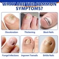 thumbnail image 3 of Parches de tratamiento para uñas de los pies GZGULTMV Extra Strength 32 piezas, 3 of 9